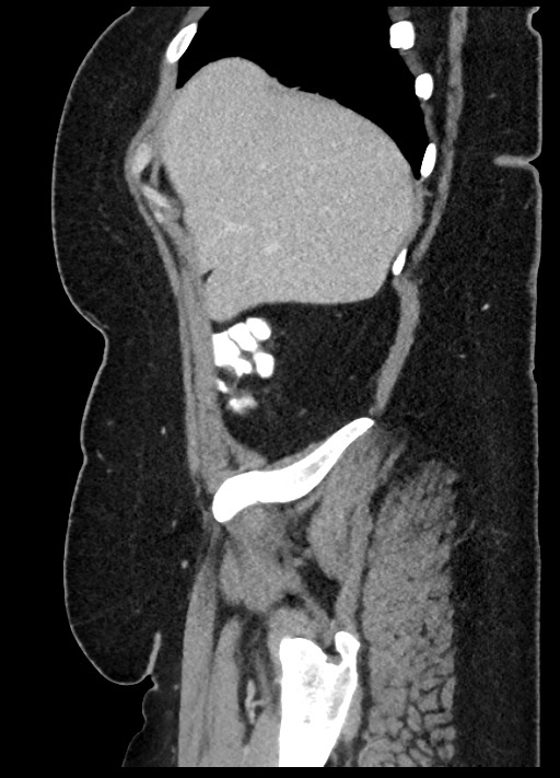 Carcinoid tumor - terminal ileum (Radiopaedia 60931-68739 C 88).jpg