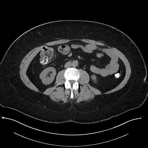 Carcinoid tumor - terminal ileum (Radiopaedia 60931-68740 Axial non-contrast 58).jpg