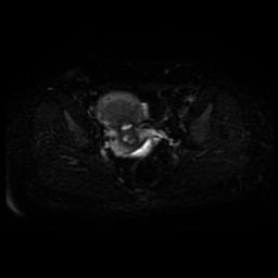 Carcinoma of the cervix (Radiopaedia 89018-105858 Axial DWI 15).jpg