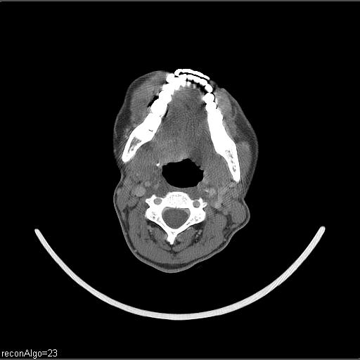 File:Carcinoma of the maxillary antrum (Radiopaedia 53805-59888 Axial C+ delayed 34).jpg