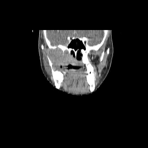 Carcinoma of the maxillary antrum (Radiopaedia 53805-59888 Coronal C+ delayed 59).jpg