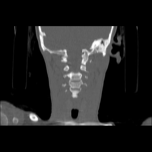 Carcinoma of the maxillary antrum (Radiopaedia 53805-59888 Coronal bone window 102).jpg