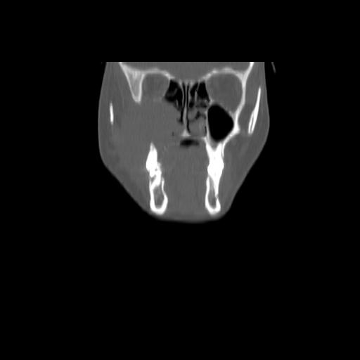 Carcinoma of the maxillary antrum (Radiopaedia 53805-59888 Coronal bone window 39).jpg