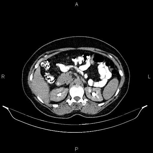 File:Carcinoma of uterine cervix (Radiopaedia 85861-101700 Axial C+ delayed 19).jpg