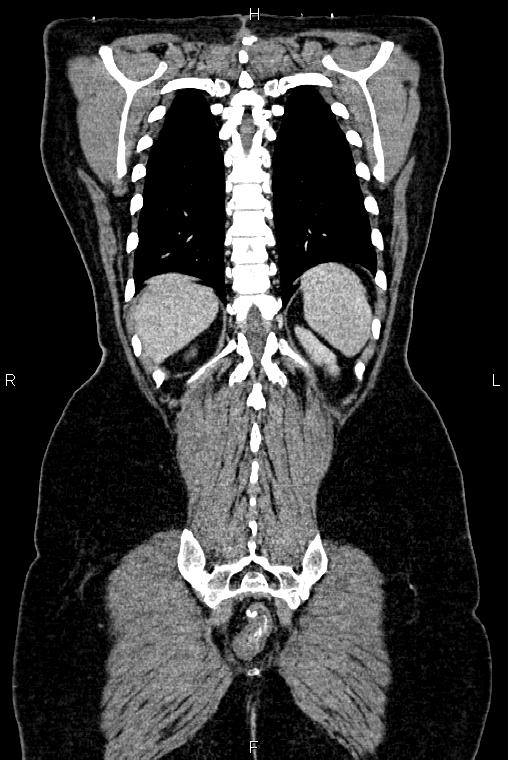 Carcinoma of uterine cervix (Radiopaedia 85861-101700 C 49).jpg