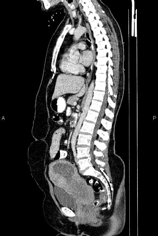 Carcinoma of uterine cervix (Radiopaedia 85861-101700 D 43).jpg