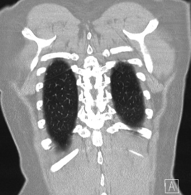 File:Cardiac sarcoidosis (Radiopaedia 74548-85534 Coronal lung window 62).jpg