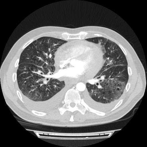 Cardiac tamponade (Radiopaedia 78607-91368 Axial lung window 52).jpg