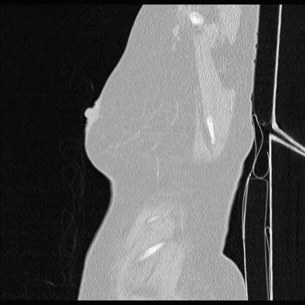 Cardiogenic pulmonary edema (Radiopaedia 29213-29609 Sagittal lung window 3).jpg