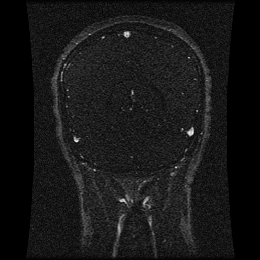 Carotid arterial dissection with acute cerebral infarction (Radiopaedia 26636-26784 MRV 66).jpg