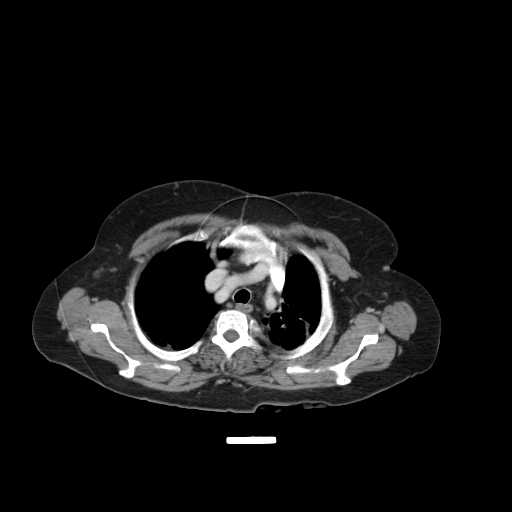 File:Carotid body tumor (Radiopaedia 21021-20948 B 28).jpg