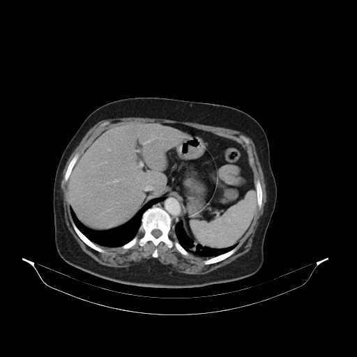File:Carotid body tumor (Radiopaedia 21021-20948 B 61).jpg