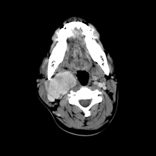 File:Carotid body tumor (Radiopaedia 27890-28124 A 14).jpg