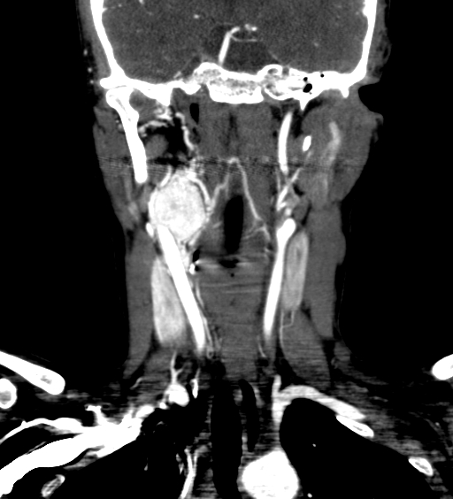 File:Carotid body tumor (Radiopaedia 39845-42300 C 34).jpg