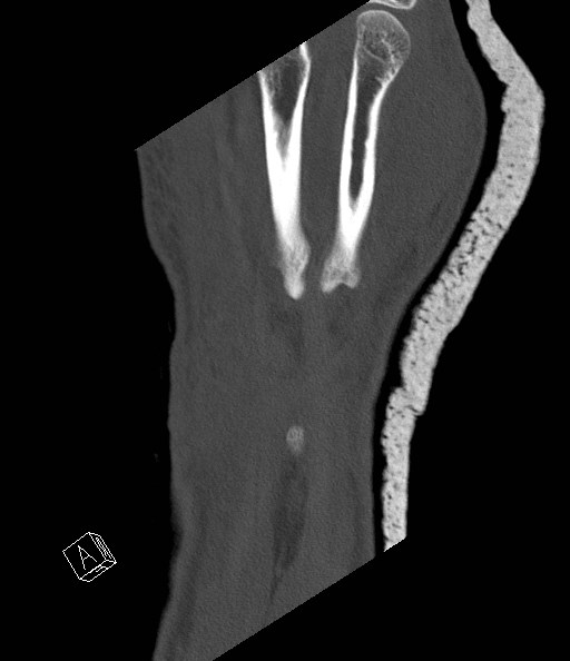 File:Carpal fractures (smart watch impaction) (Radiopaedia 55844-62430 Coronal bone window 1).jpg