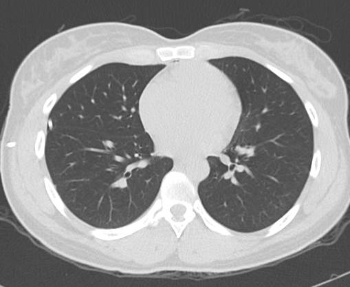 File:Catamenial pneumothorax (Radiopaedia 54382-60600 Axial 28).png