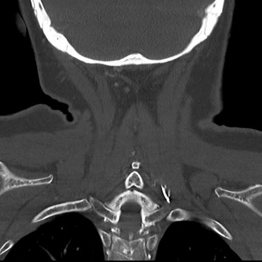 Causes of dysphagia (Radiopaedia 40149-42657 Coronal bone window 50).png
