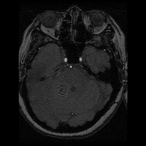 Cavernoma, DVA and right ICA aneurysm (Radiopaedia 33890-35072 E 70).png