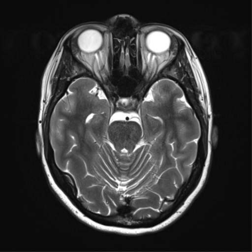 File:Cavernoma with bleed - midbrain (Radiopaedia 54546-60773 Axial T2 14).png