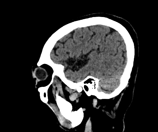 Cavernous hemangioma of the cerebellar falx (Radiopaedia 73025-83723 B 260).jpg
