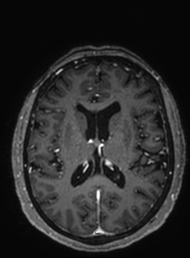 Cavernous hemangioma of the cerebellar falx (Radiopaedia 73025-83724 Axial T1 C+ 144).jpg