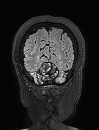 Cavernous hemangioma of the cerebellar falx (Radiopaedia 73025-83724 Coronal FLAIR 313).jpg