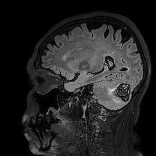 Cavernous hemangioma of the cerebellar falx (Radiopaedia 73025-83724 Sagittal FLAIR 146).jpg