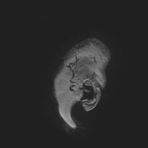 File:Cavernous hemangioma of the cerebellar falx (Radiopaedia 73025-83724 Sagittal T1 1).jpg