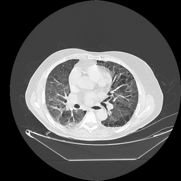 Cavitating bronchogenic carcinoma (Radiopaedia 44489-48162 Axial lung window 44).jpg