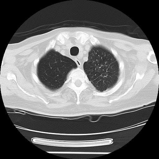 Cavitating pulmonary metastases (Radiopaedia 89545-106544 Axial lung window 8).jpg