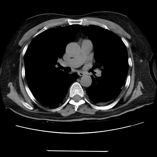 Cavitating pulmonary metastases (Radiopaedia 89545-106544 Axial non-contrast 27).jpg