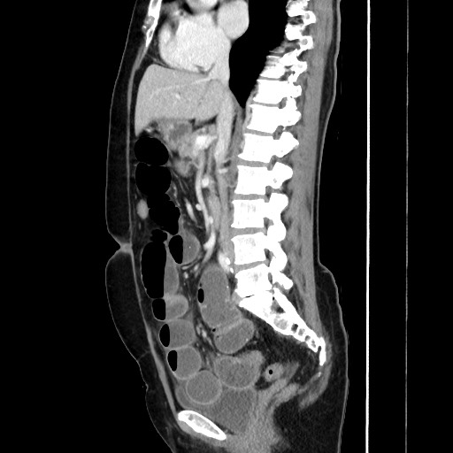 Cecal adenocarcinoma (Radiopaedia 75909-87331 C 36).jpg