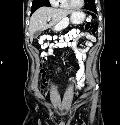 Cecal adenocarcinoma (Radiopaedia 85324-100916 D 16).jpg