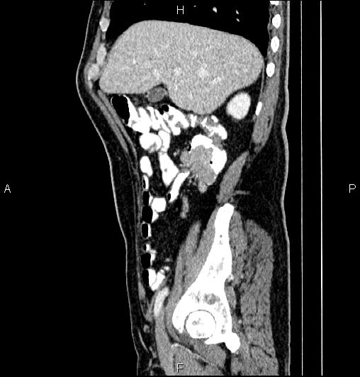 Cecal adenocarcinoma (Radiopaedia 85324-100916 E 23).jpg