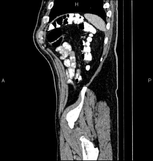 Cecal adenocarcinoma (Radiopaedia 85324-100916 E 82).jpg