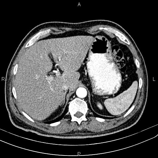 File:Cecal cancer with appendiceal mucocele (Radiopaedia 91080-108651 A 62).jpg