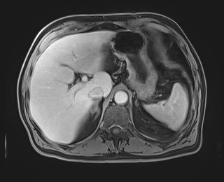 Cecal mass causing appendicitis (Radiopaedia 59207-66532 J 37).jpg