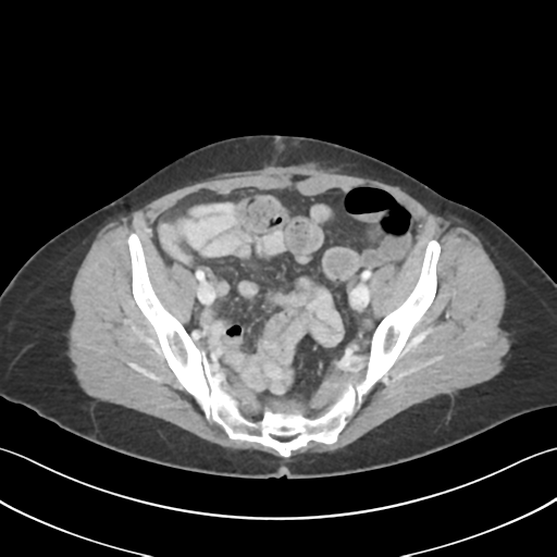 Cecum hernia through the foramen of Winslow (Radiopaedia 46634-51112 A 58).png