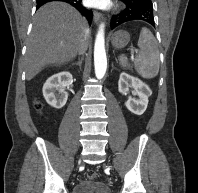 Celiac artery dissection (Radiopaedia 52194-58080 C 91).jpg