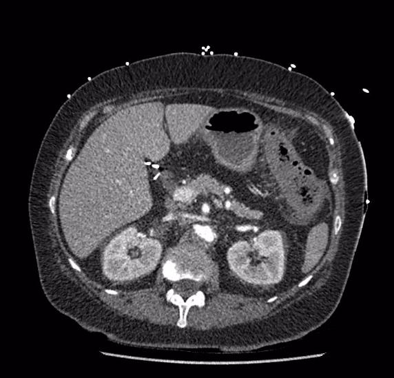 Celiac artery severe stenosis and dissection (Radiopaedia 44128-47842 B 29).jpg