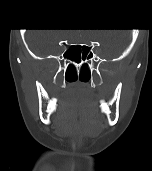 Cemento-ossifying fibroma (Radiopaedia 46243-50643 Coronal bone window 29).png