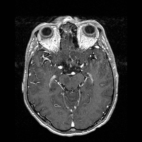 Central-variant posterior reversible encephalopathy syndrome (PRES) (Radiopaedia 43880-47358 Axial T1 C+ 63).jpg