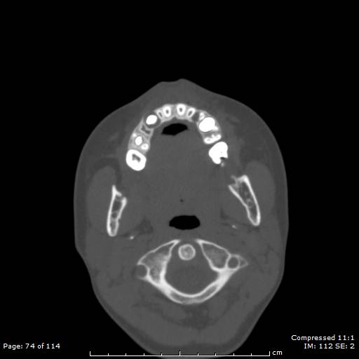 File:Central giant cell granuloma (Radiopaedia 45612-49754 Axial bone window 37).jpg
