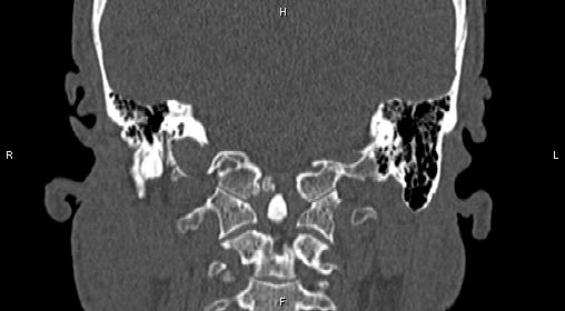 File:Central giant cell granuloma (Radiopaedia 83346-97761 Coronal bone window 35).jpg
