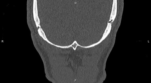 Central giant cell granuloma (Radiopaedia 83346-97761 Coronal bone window 50).jpg