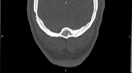 Central giant cell granuloma (Radiopaedia 83346-97761 Coronal bone window 54).jpg