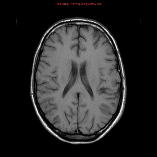 File:Central nervous system vasculitis (Radiopaedia 8410-9235 Axial T1 15).jpg