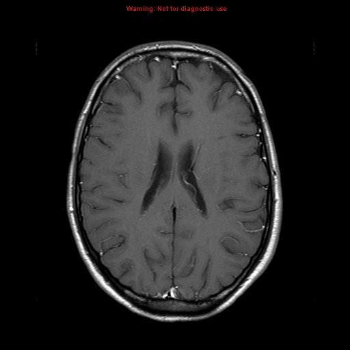 File:Central nervous system vasculitis (Radiopaedia 8410-9235 Axial T1 C+ 15).jpg