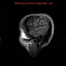 File:Central nervous system vasculitis (Radiopaedia 8410-9235 Sagittal T1 2).jpg