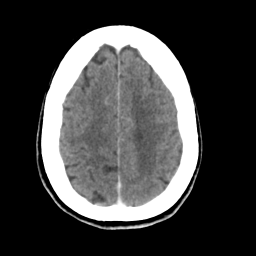 Central neurocytoma (Radiopaedia 65317-74346 Axial C+ delayed 39).png